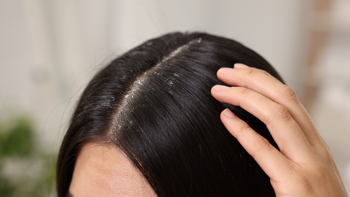 Dry Scalp vs Dandruff: How to Tell the Difference (and Fix It)